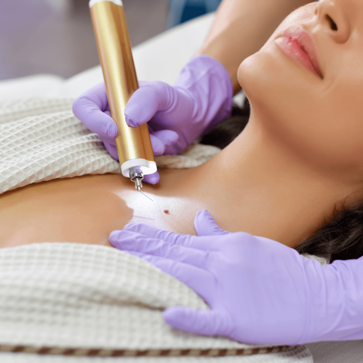 woman getting a mole removal procedure 