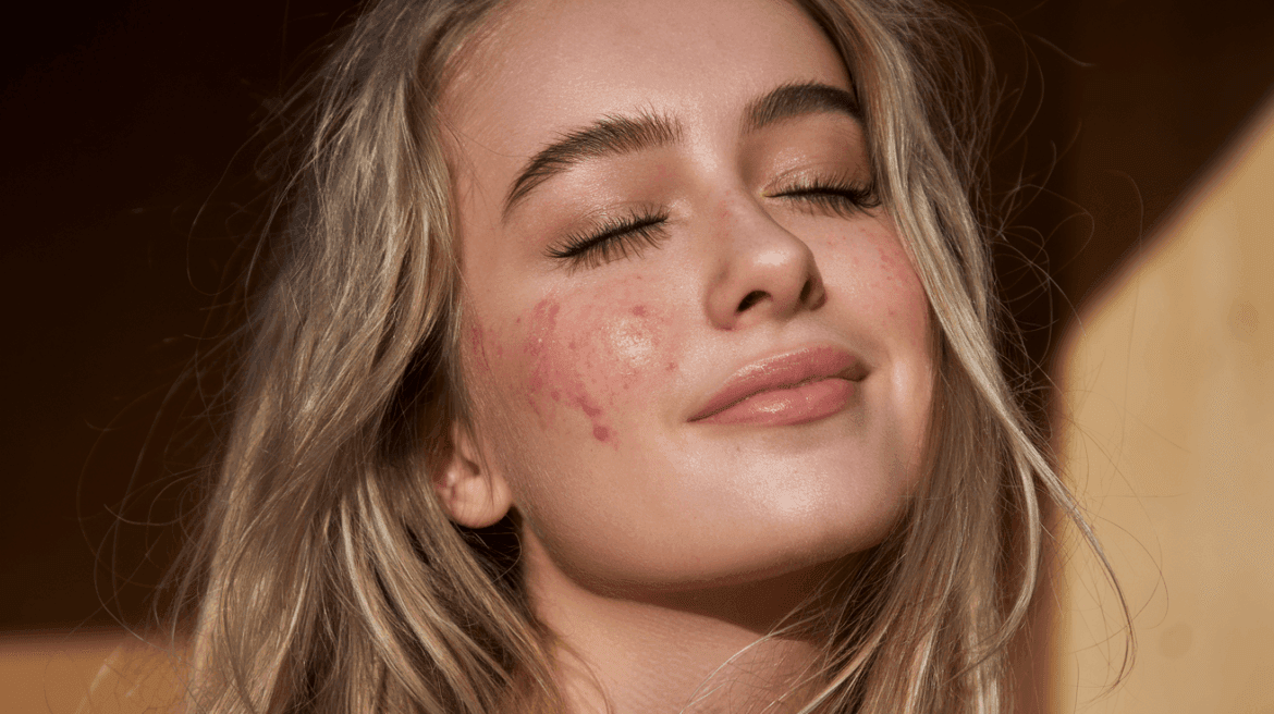 beautiful young woman with acne scars