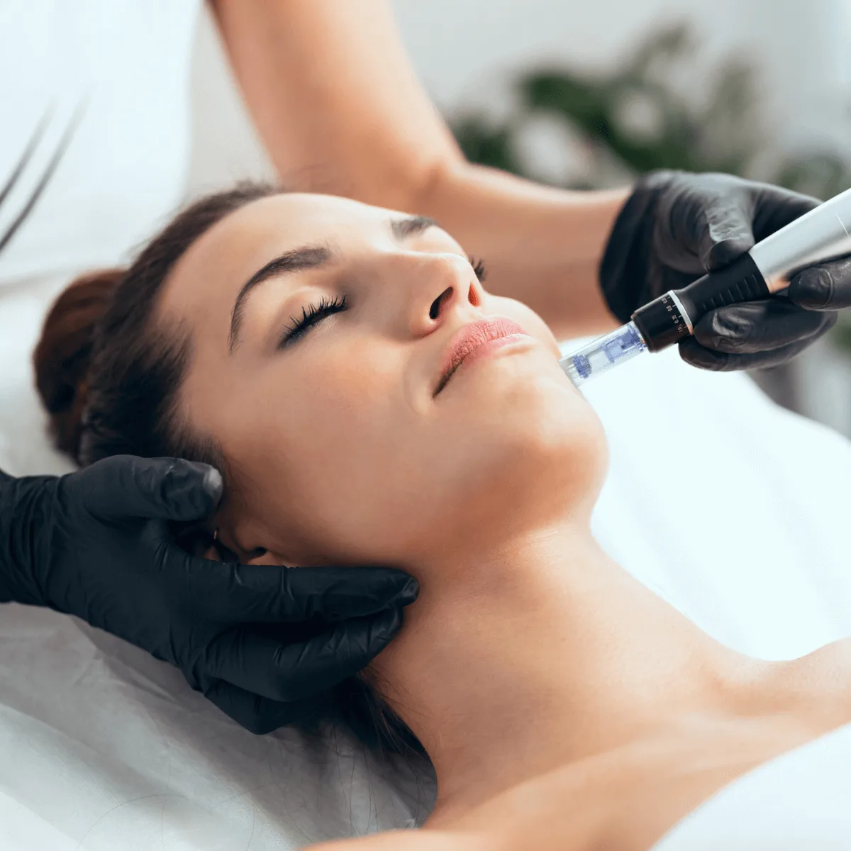 woman getting a microneedling treatment