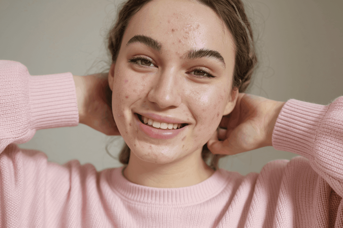 A photo of a young woman with light acne