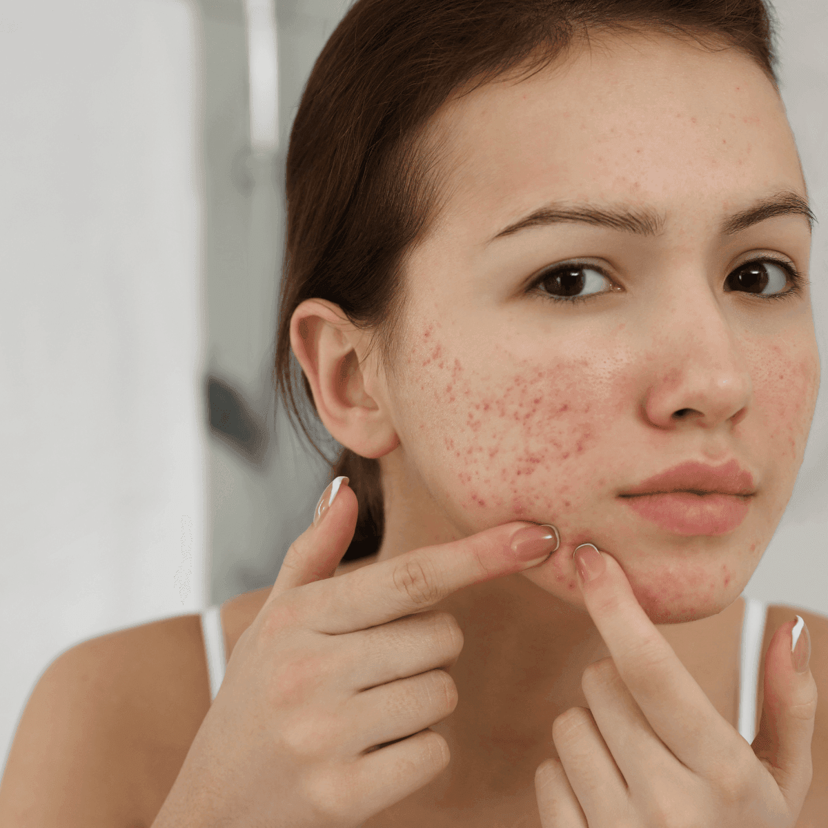 woman with acne