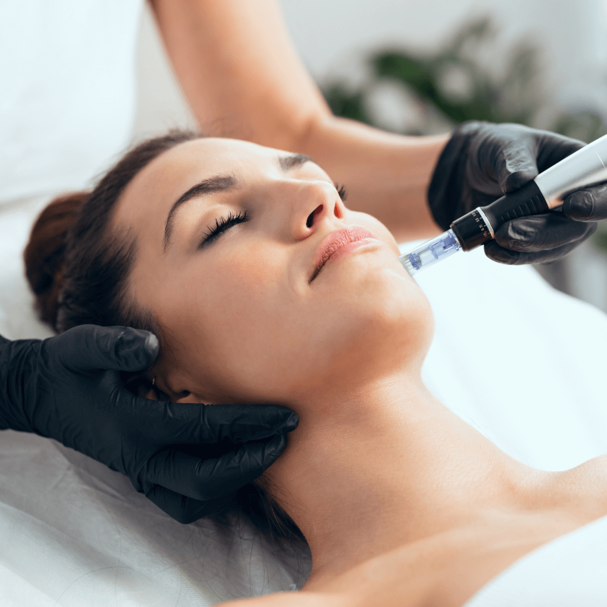 a professional microneedling treatment