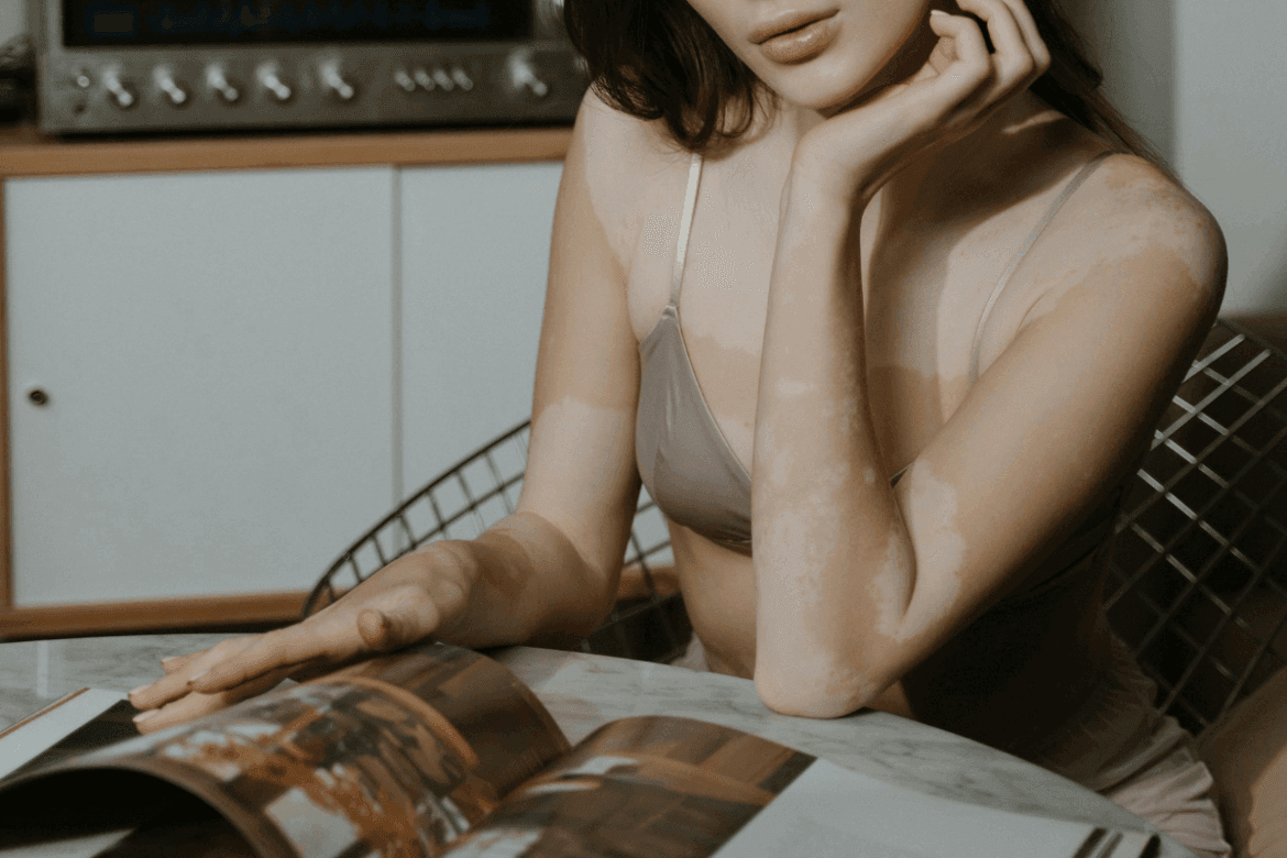 woman with hypopigmentation on her body