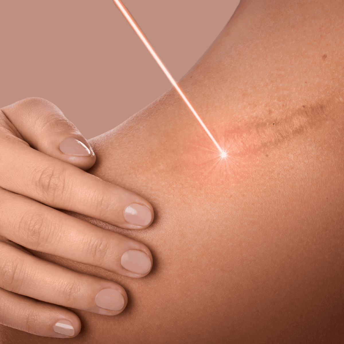 laser scar treatment