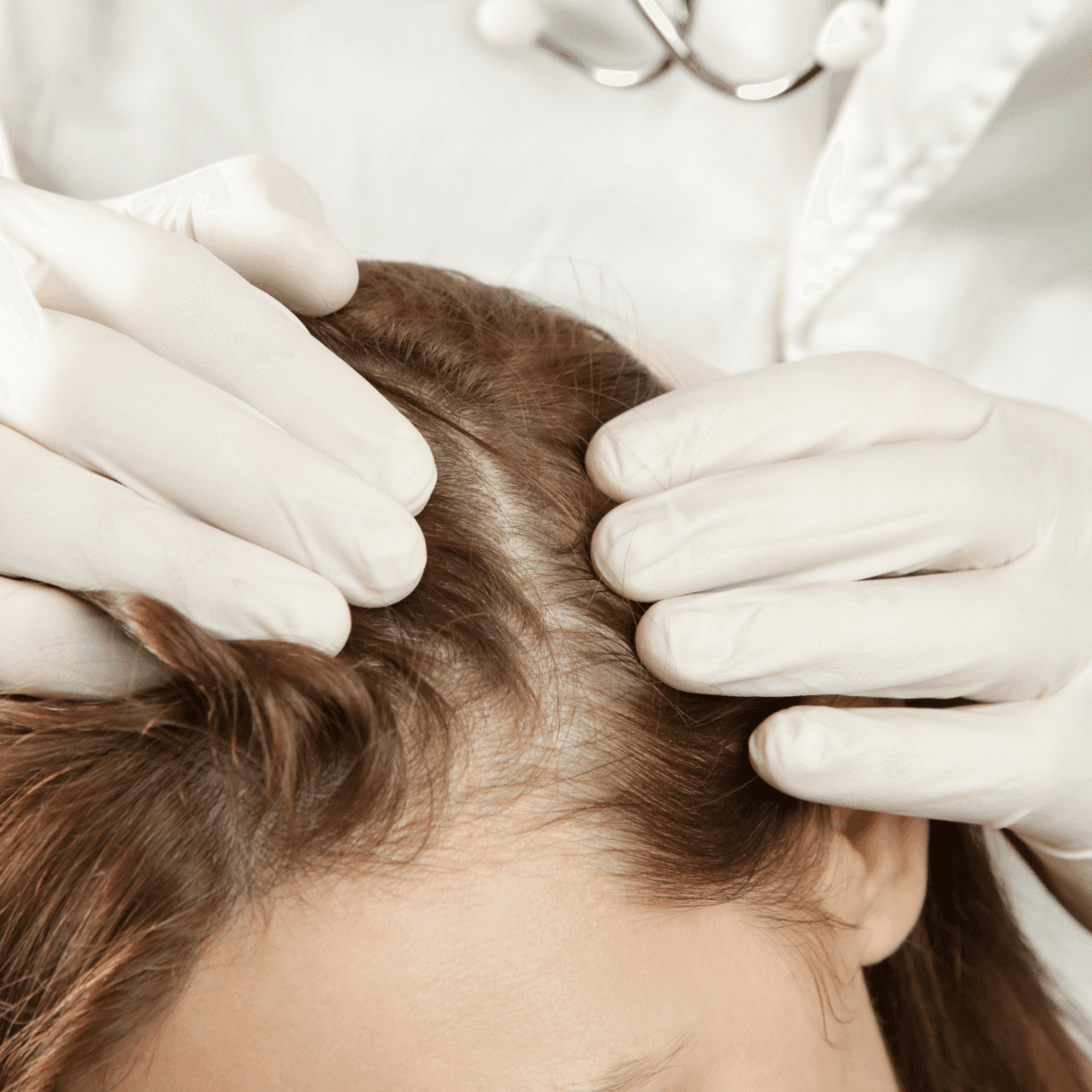 seborrheic dermatitis scalp