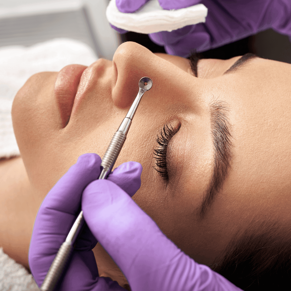 manual blackheads extraction treatment