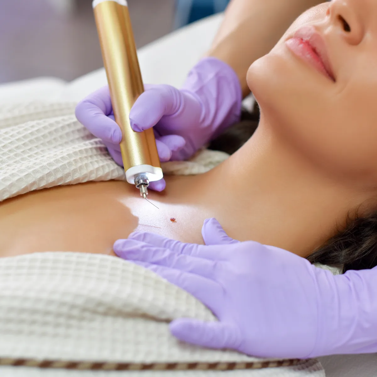 mole removal procedure 